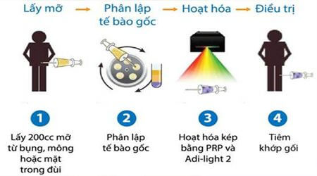Quy trình chữa viêm khớp gối bằng tế bào gốc
